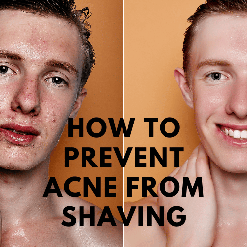 How to Prevent Acne from Shaving
