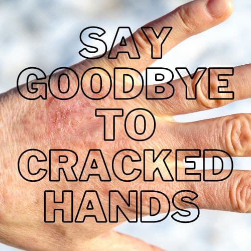 cracked hands